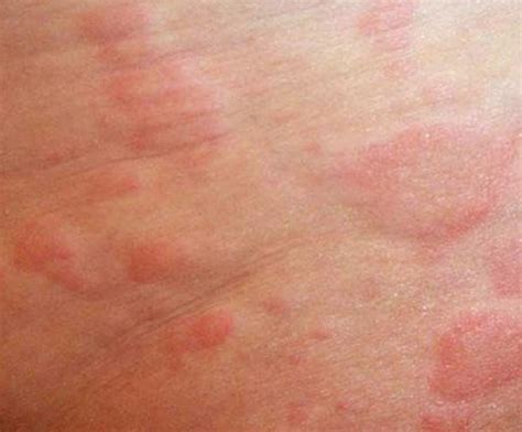 Itchy Skin Rash Pictures Causes Symptoms Treatment