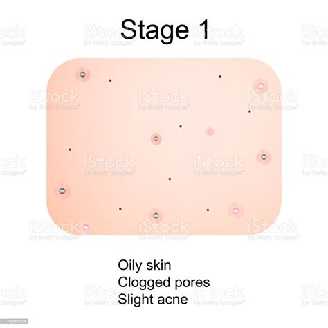 Stage 1 Of Development Of Acne Inflamed Skin With Scars Acne And