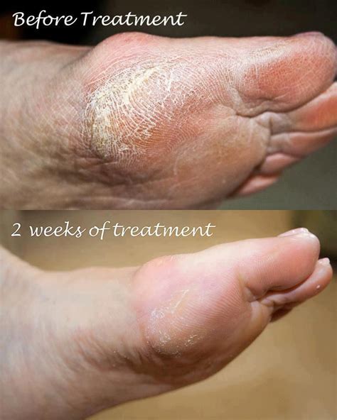 Dry Cracked Feet Try Skincerity Sarah10mynuceritybiz Dry