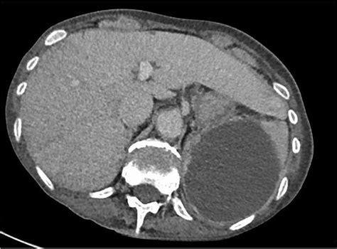Splenic Abscess As A Potential Initial Manifestation Of Quiescent