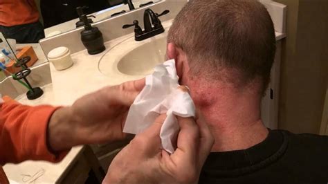 Pimple Sebaceous Cyst Popping