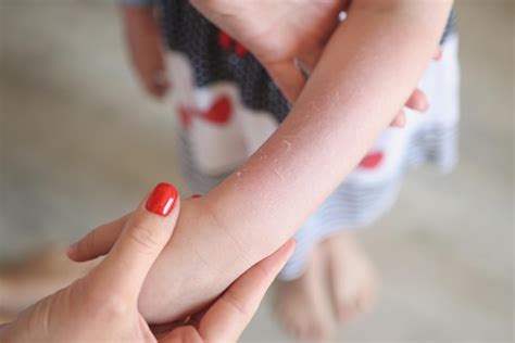 Premium Photo Woman Examining Red Rash On Arms Of Child Irritation On