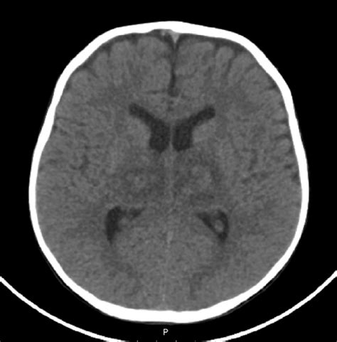 Brain Ct Scan Bilateral Thalamic Hypodensities More Marked On The Left