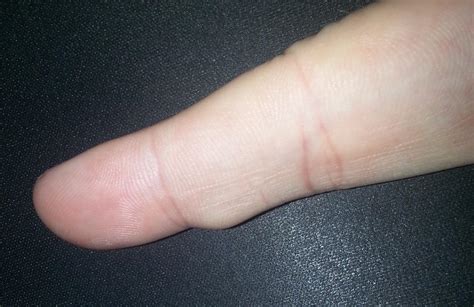 What Is This Bump On My Finger Cyst Painful Infection Health And Vrogue