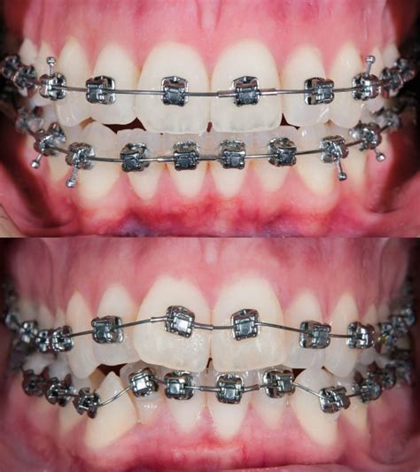 Stages Of Change In Braces Orthodontic Associates