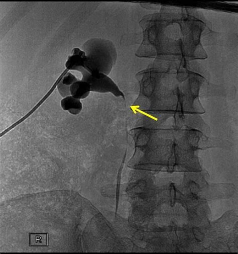 Erdheimchester Disease Ecr 2014 Case Of The Day Eurorad