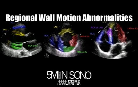 5 Minute Sono Regional Wall Motion Abnormalities Core Ultrasound