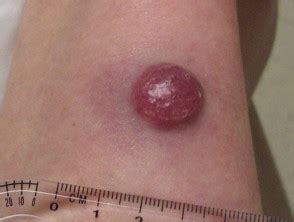 Gale encyclopedia of cancer dictionary. Merkel cell carcinoma | DermNet NZ