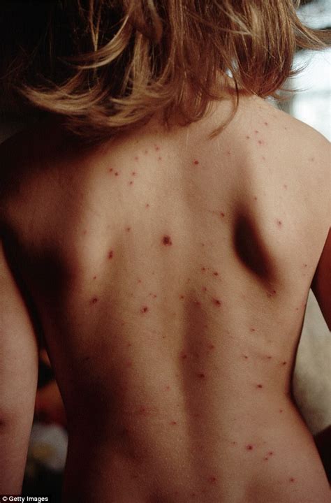 Hundreds At Risk Of Catching Measles After Perth Man