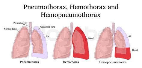 Illustration Of Pneumothorax Hemothorax And Hemopneumothorax Stock Vector Colourbox
