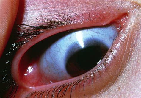 Blue Sclera Of Eye In Osteogenesis Imperfecta Photograph By James