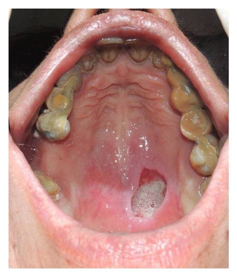 Deep Crateriform Ulcer Of The Palatal Mucosa Located At The Left Side