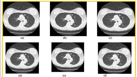Deep Learning For Lung Cancer Detection And Classification Article