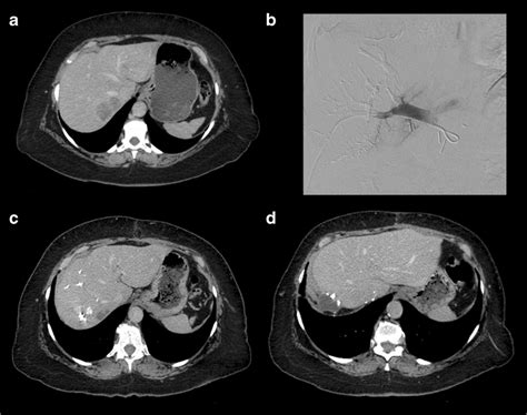 Portal Vein Embolisation Prior To Right Hepatectomy A Axial Enhanced