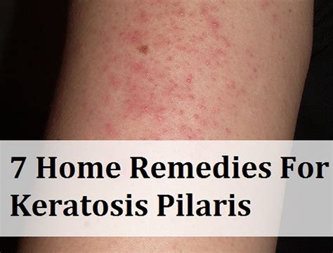 7 Home Remedies For Keratosis Pilaris