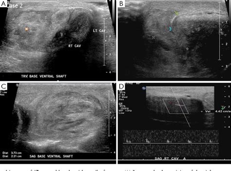 Penile Fracture Role Of Ultrasound Semantic Scholar