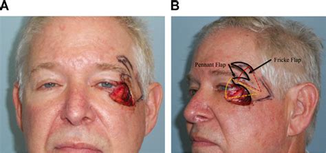 Reconstruction Of Combined Full Thickness Defect Of The Lateral Canthus