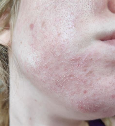 Folliculitis Face