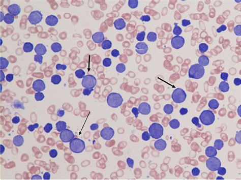 Cureus Cd5 Diffuse Large B Cell Lymphoma With Leukemic
