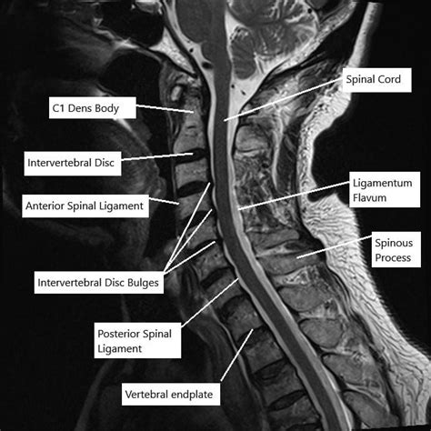 Mri Cervical Spine Lumbar Spine Mri Scan Images Spinal Stenosis
