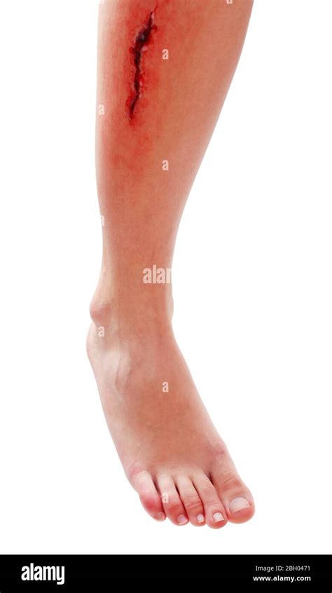 Injured Leg With Blood Isolated On White Stock Photo Alamy