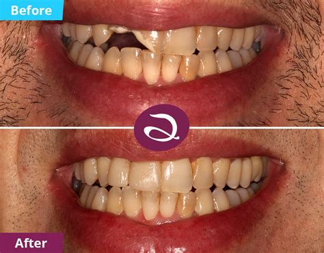 Cosmetic Dentistry Before And After From Aspects Dental In Milton Keynes