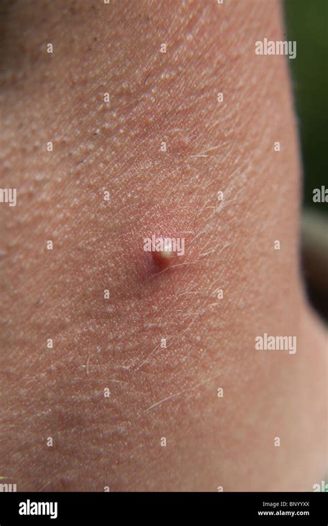 Large Acne Spot Or Pimple On A Mans Neck Stock Photo Alamy