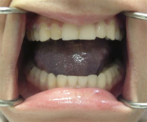 Lingual Hematoma Treatment Rationales A Case Report Journal Of Oral