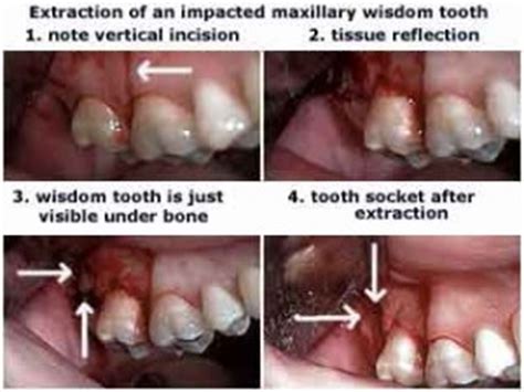 Guide To Wisdom Teeth Removal Intelligent Dental