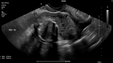 31 Uterine Fibroids Ultrasound Appearance