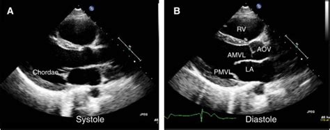 Parasternal View Of Normal Mitral Valve A In Systole Leaflets Are