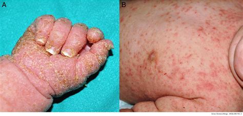 Diffuse Erythema And Acral Hyperkeratosis In A Newborn Actas Dermo