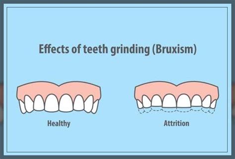 Teeth Grinding Causes Symptoms And Treatment Repc