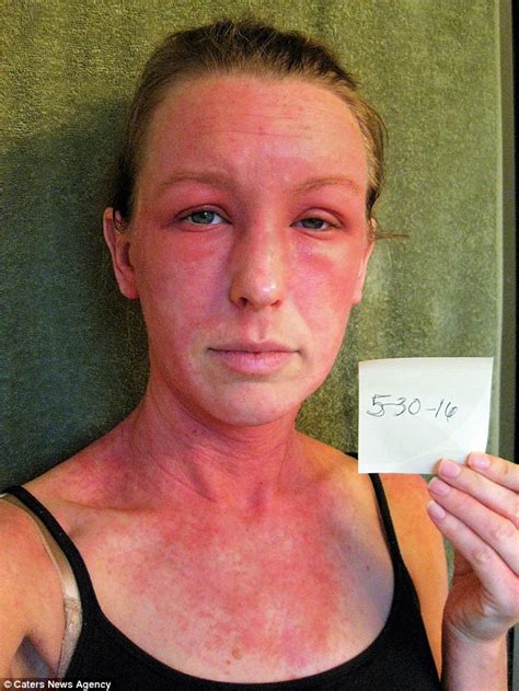 Horrific Reaction To Steroids Leaves Mother Feeling Like She S Been Stung By 1 000 Bees