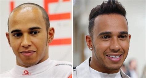 The best procedure is on route to plug hair mascle get hair implant. Celebrity hair loss: Lewis Hamilton : tressless