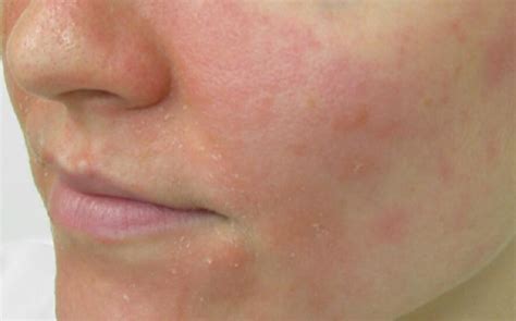 Eczema Assurance Skin