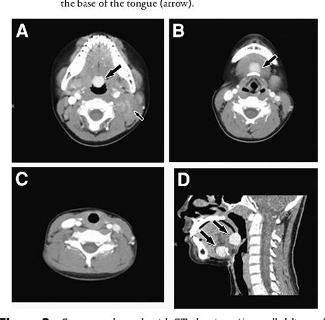 Figure 2 From Dual Ectopic Thyroid With Lingual And Anterior Hyoid