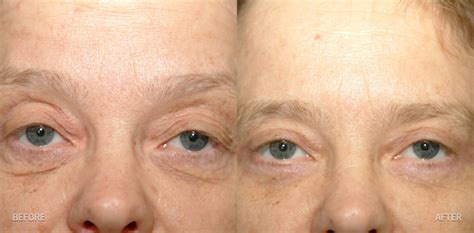 Pinch Blepharoplasty 17 Lorne K Rosenfield