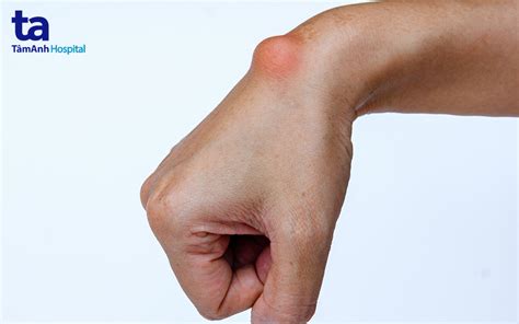 Viêm bao hoạt dịch cổ tay Nguyên nhân dấu hiệu và cách điều trị