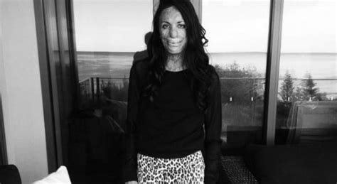 Turia Pitt Interview About Interplast And Turia S Fitness Routine
