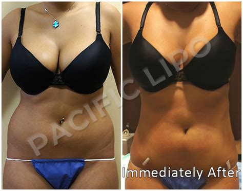 Pacific Lipo Patient Immediately After A Love Handles And Flank
