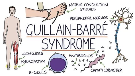 Understanding Guillain Barré Syndrome YouTube