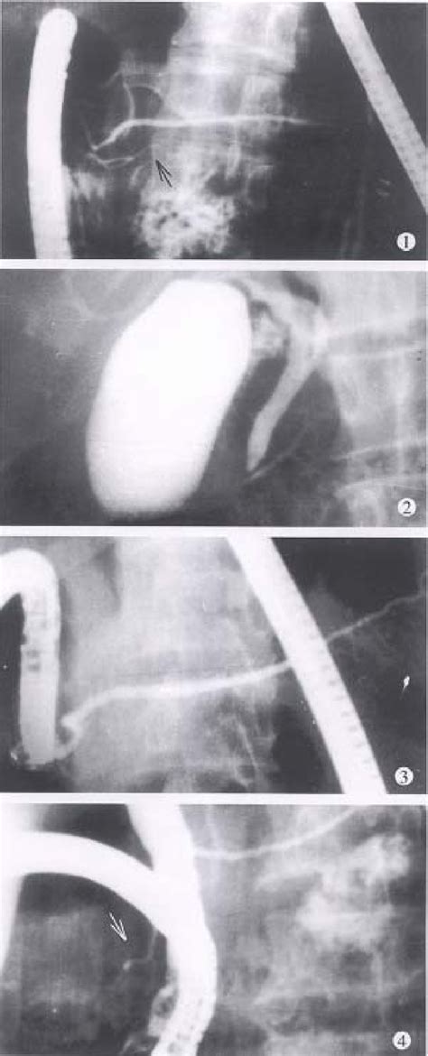 Figure 1 From Ercp And Ct Diagnosis Of Pancreas Divisum And Its