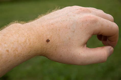 Common Insect Bites And Stings In Central Pennsylvania Upmc Healthbeat