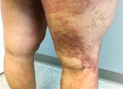 A Year Old With Erythematous Dusky Patches On Both Lower Extremities MDedge Dermatology
