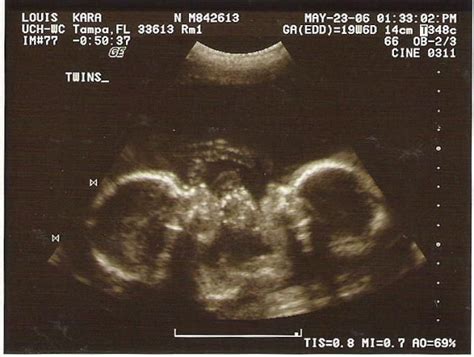 How An Ultrasound Can Reveal If You Are Carrying A Hidden Twin Twins