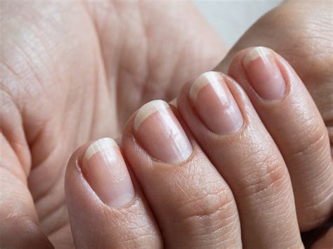 Onycholysis A Condition Where Nails Separate From The Nail Bed