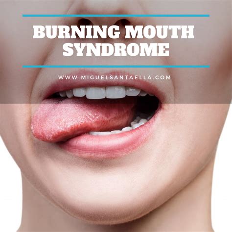 🔥 Symptoms Of Burning Mouth Syndrome 🔥 Burning Or Scalded Sensation In