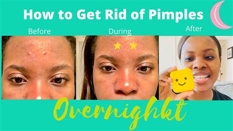 Starface Pimple Patch Review 2020⎢ How To Get Rid Of Pimples Overnight