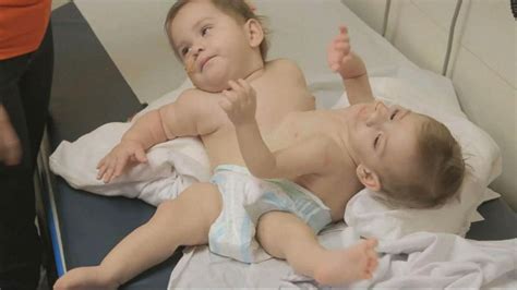 Video Conjoined Twins Survive A Successful Surgery Separating Them